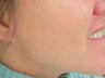 Photofacial Laser Treatment