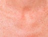 IPL Treatment for Chest