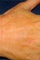 IPL for Hands