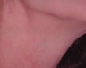 IPL Treatment for Neck