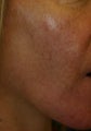 IPL for the face