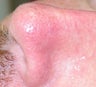 Intense Pulsed Light for broken blood vessel