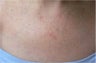 IPL for decollete sun damage