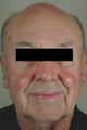 Pulsed Dye Laser Treatment for Rosacea 