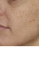 Alexandrite and IPL (Intense pulsed light)  treatment