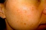 IPL for Acne