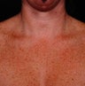 IPL for Chest