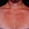 IPL for Chest