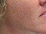 Photofacial Laser Treatment