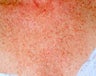 IPL Treatment for Chest