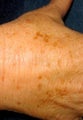 IPL for Hands