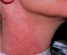 IPL Treatment for Neck