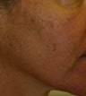 IPL for the face