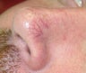Intense Pulsed Light for broken blood vessel