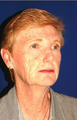 Facelift, Intense Pulsed Light