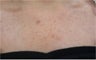 IPL for decollete sun damage