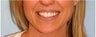 Invisalign
