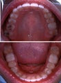 Invisalign