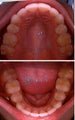 Invisalign
