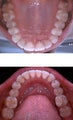Invisalign