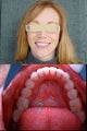 Invisalign