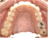 Invisalign