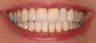 Invisalign
