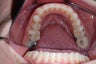 Invisalign
