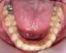 Invisalign