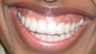 Invisalign