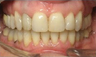 Invisalign