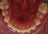 Invisalign