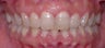 Invisalign