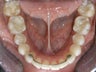 Invisalign