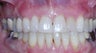 Invisalign correction of crowding