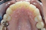 Invisalign: dramatic rotation of front teeth