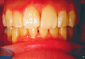 Complex orthodontics with Invisalign