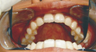 The Hollywood smile with Invisalign