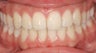 Upper Jaw Expander, Invisalign