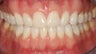 Braces and Invisalign