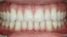 Gaps and Teeth Spacing