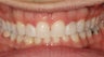 Gaps, Overbite, Invisalign