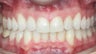 Narrow Arches, Crowding, Invisalign