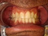 Pushing down lower teeth with Invisalign