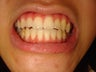 Pushing teeth over the bite and reversing a crossbite