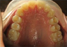 Invisalign