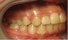 Invisalign