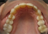 Invisalign Treatment
