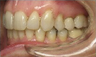 Invisalign Treatment