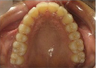 Invisalign Treatment